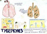 Украина с туберкулезом будет бороться в одиночку