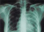 Украина вторая в Европе по заболеваемости туберкулезом