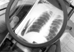 Депутаты предлагают наказывать больных туберкулезом, которые не хотят лечиться