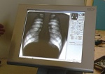Вместо флюорографии харьковчанам будут делать рентген